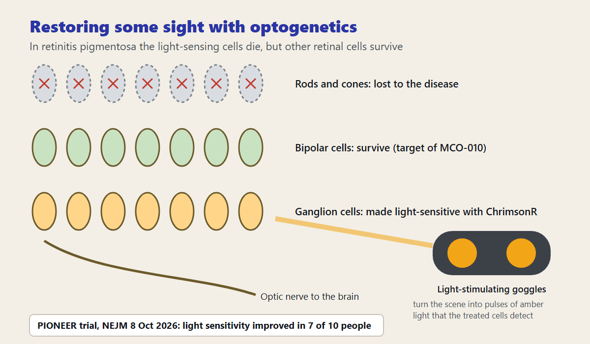 Diagram of optogenetic vision therapy in retinitis pigmentosa: lost rods and cones, surviving bipolar and ganglion cells made light-sensitive, and light-stimulating goggles
